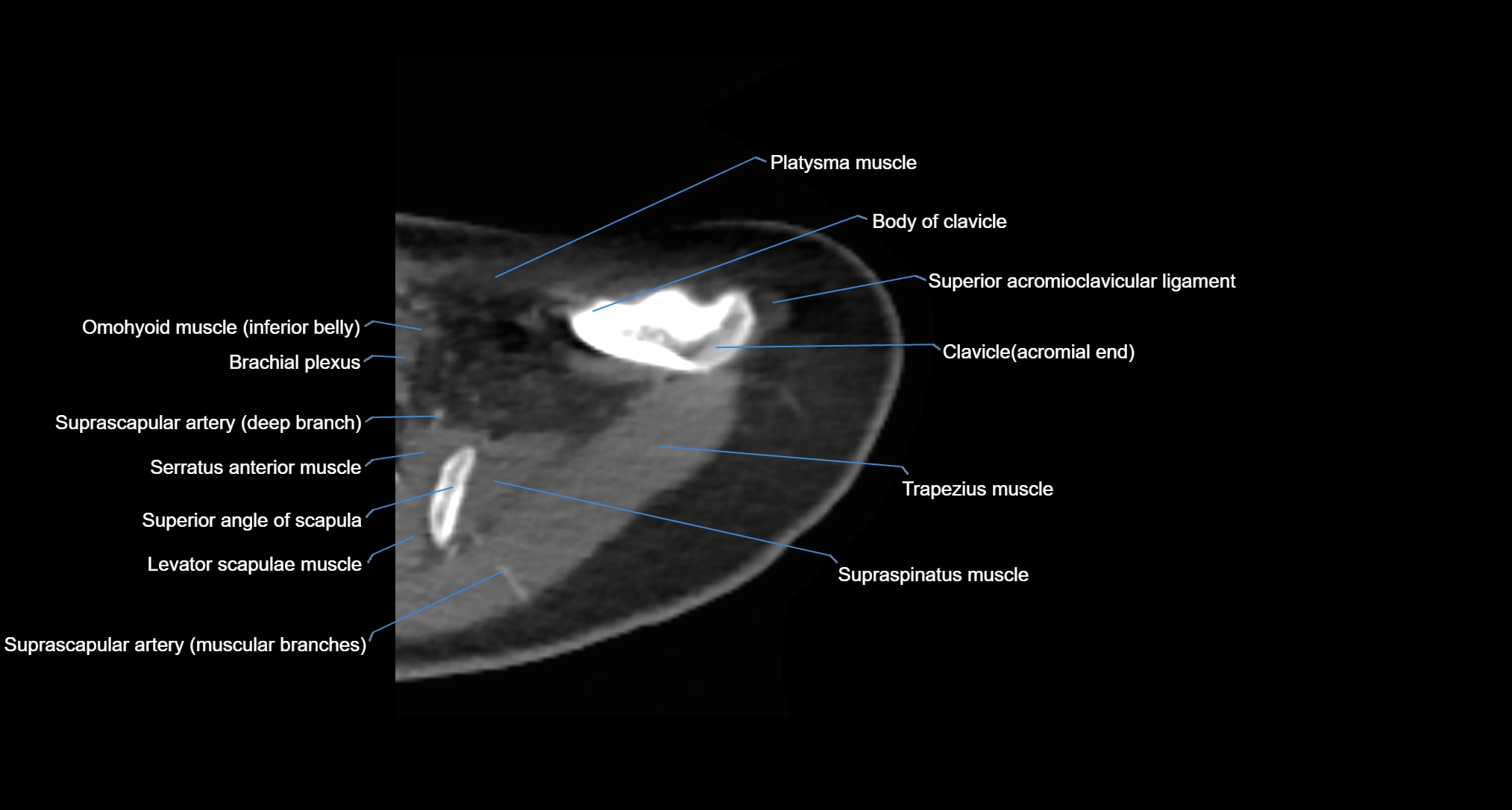 CT Shoulder axial cross sectional anatomy labelled radiology image -00012.webp